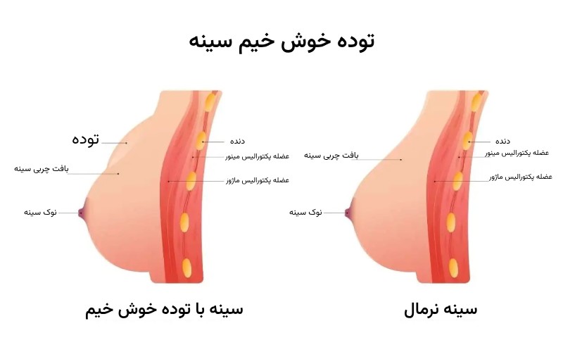 توده خوش خيم سينه