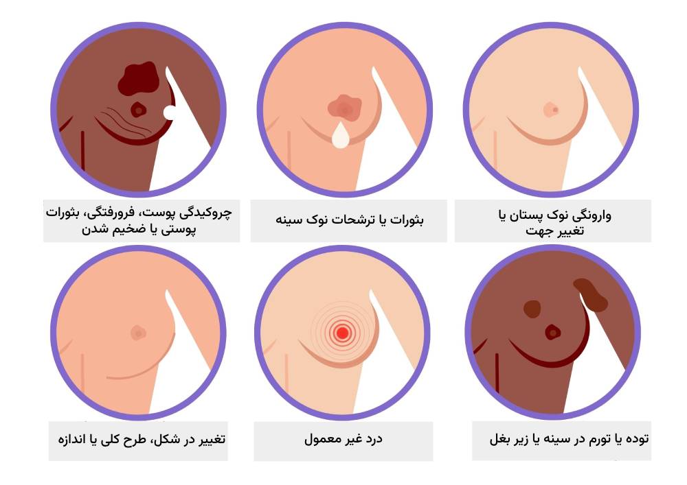 علائم هشدار دهنده سرطان سینه