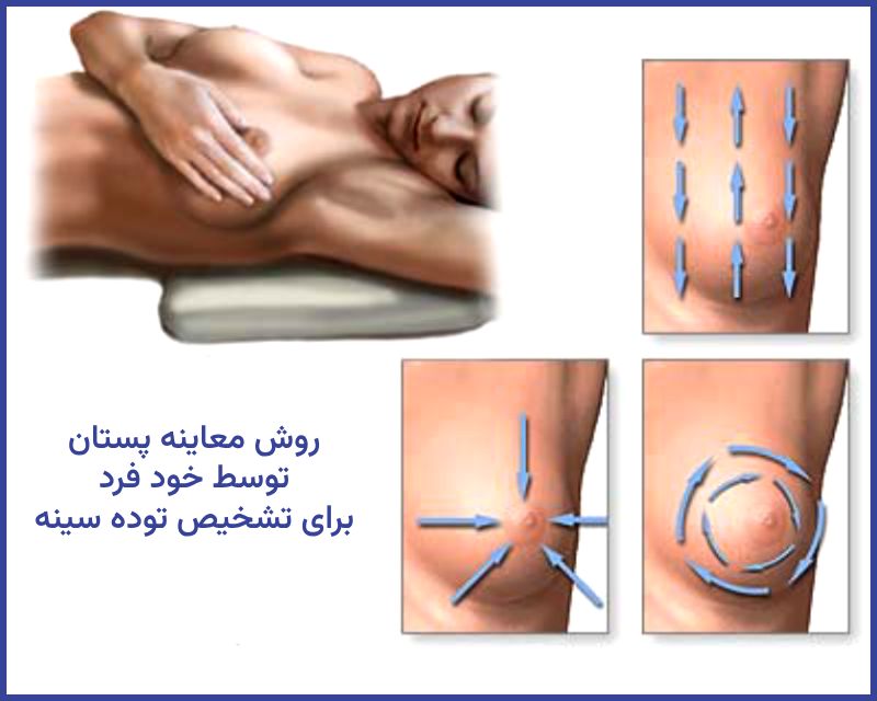 معاینه سینه توسط خود در فرد برای تشخیص توده در سینه