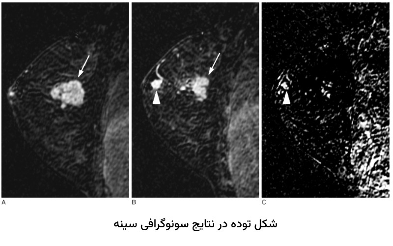 شکل توده پستان در نتایج سونوگرافی