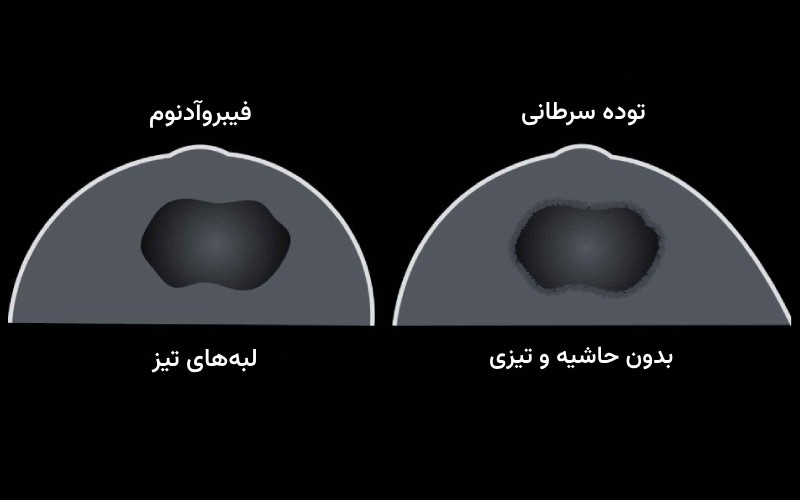 فيبروآدنوم سينه به معنی توده غیر سرطانی پستان است